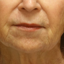 Restylane Refyne Before & After Patient #24244