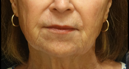 Restylane Refyne Before & After Patient #24244