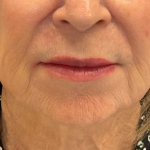 Restylane Refyne Before & After Patient #24244