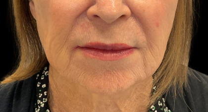 Restylane Refyne Before & After Patient #24244