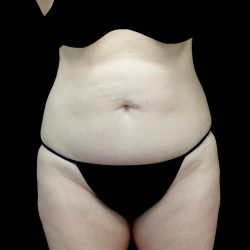Tummy Tuck Before & After Patient #24245