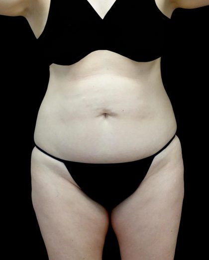 Tummy Tuck Before & After Patient #24245