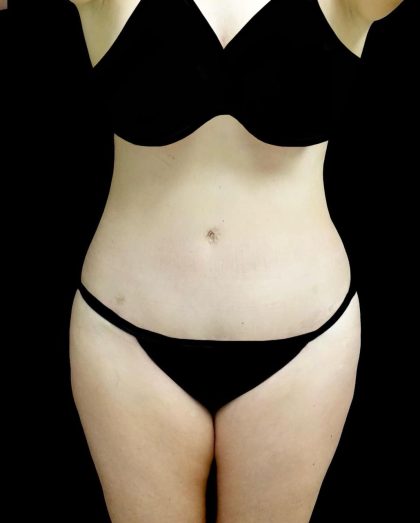 Tummy Tuck Before & After Patient #24245