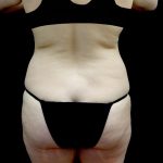 Tummy Tuck Before & After Patient #24245