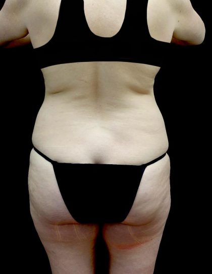 Tummy Tuck Before & After Patient #24245