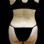 Tummy Tuck Before & After Patient #24245