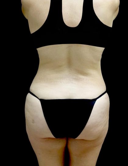 Tummy Tuck Before & After Patient #24245
