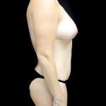 Breast Augmentation (Fat Transfer) Before & After Patient #24212