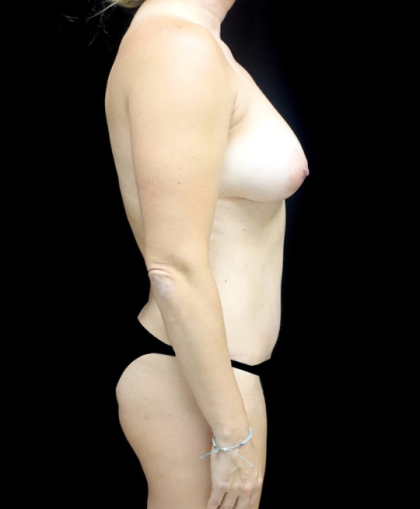 Breast Augmentation (Fat Transfer) Before & After Patient #24212