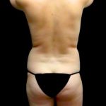 Breast Augmentation (Fat Transfer) Before & After Patient #24212