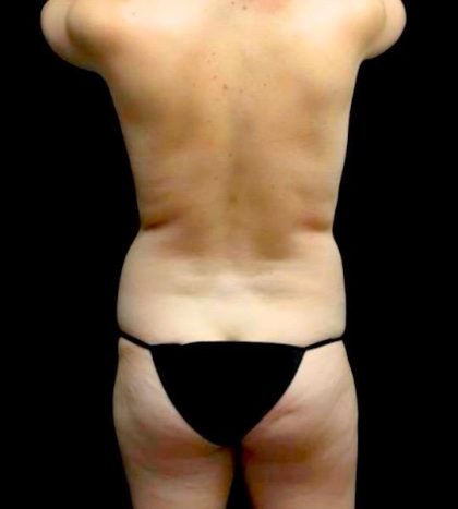 Breast Augmentation (Fat Transfer) Before & After Patient #24212