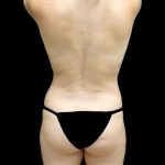 Breast Augmentation (Fat Transfer) Before & After Patient #24212