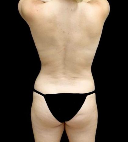 Breast Augmentation (Fat Transfer) Before & After Patient #24212