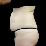 Tummy Tuck Before & After Patient #24245