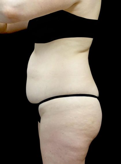 Tummy Tuck Before & After Patient #24245
