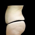 Tummy Tuck Before & After Patient #24245