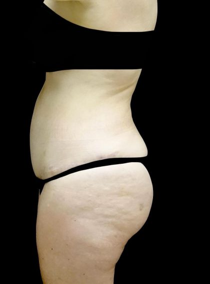 Tummy Tuck Before & After Patient #24245