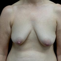 Breast Augmentation (Fat Transfer) Before & After Patient #24246