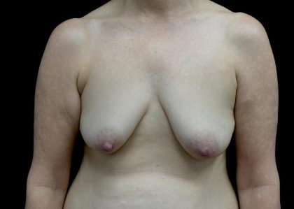 Breast Augmentation (Fat Transfer) Before & After Patient #24246