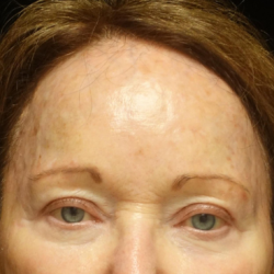 Fillers & Injectables Before & After Patient #24213