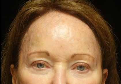 Fillers & Injectables Before & After Patient #24213