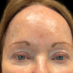 Fillers & Injectables Before & After Patient #24213