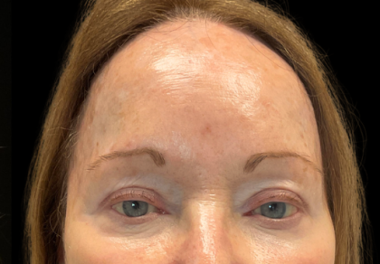 Fillers & Injectables Before & After Patient #24213