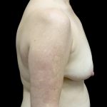 Breast Augmentation (Fat Transfer) Before & After Patient #24246