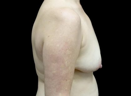 Breast Augmentation (Fat Transfer) Before & After Patient #24246