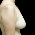 Breast Augmentation (Fat Transfer) Before & After Patient #24246