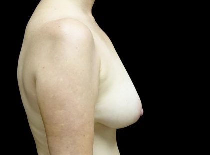 Breast Augmentation (Fat Transfer) Before & After Patient #24246