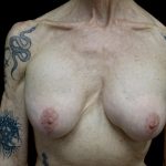Breast Revision Before & After Patient #24214