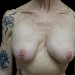 Breast Revision Before & After Patient #24214