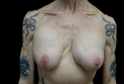 Breast Revision Before & After Patient #24214