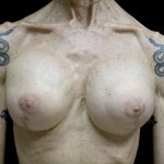Breast Revision Before & After Patient #24214