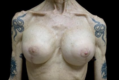 Breast Revision Before & After Patient #24214