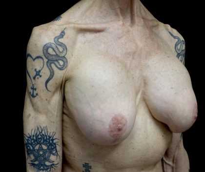 Breast Revision Before & After Patient #24214