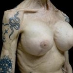 Breast Revision Before & After Patient #24214