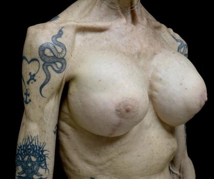 Breast Revision Before & After Patient #24214