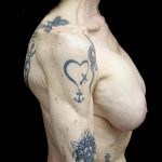 Breast Revision Before & After Patient #24214