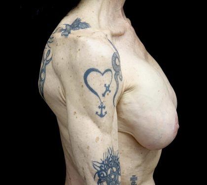 Breast Revision Before & After Patient #24214