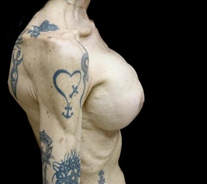 Breast Revision Before & After Patient #24214