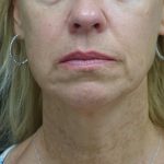 Chin & Jawline Filler Before & After Patient #24359