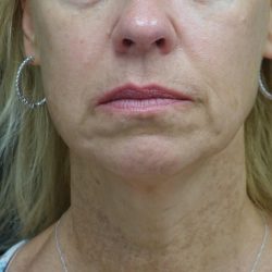 Chin & Jawline Filler Before & After Patient #24359