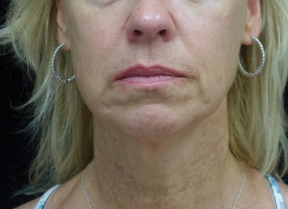 Chin & Jawline Filler Before & After Patient #24359