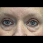 Blepharoplasty Before & After Patient #24403