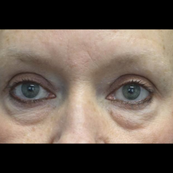 Blepharoplasty Before & After Patient #24403