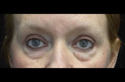 Blepharoplasty Before & After Patient #24403
