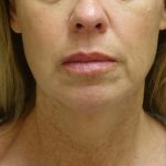 Chin & Jawline Filler Before & After Patient #24359
