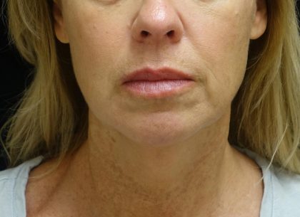 Chin & Jawline Filler Before & After Patient #24359